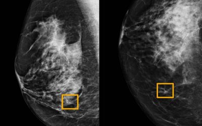 AI Provides a Helping Hand in Breast Cancer Screening
