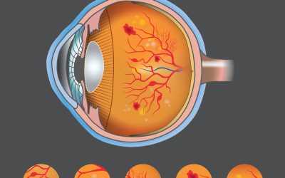 Eyenuk Announces FDA Clearance for EyeArt Autonomous AI System for Diabetic Retinopathy Screening