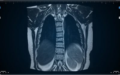 AI helps identify abnormalities in CT lung scans