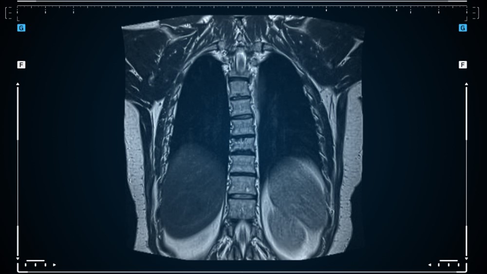 AI helps identify abnormalities in CT lung scans