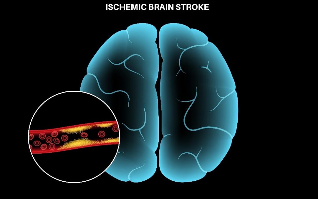 Sensome Receives FDA “Breakthrough Device Designation” for its AI-powered Stroke Guidewire